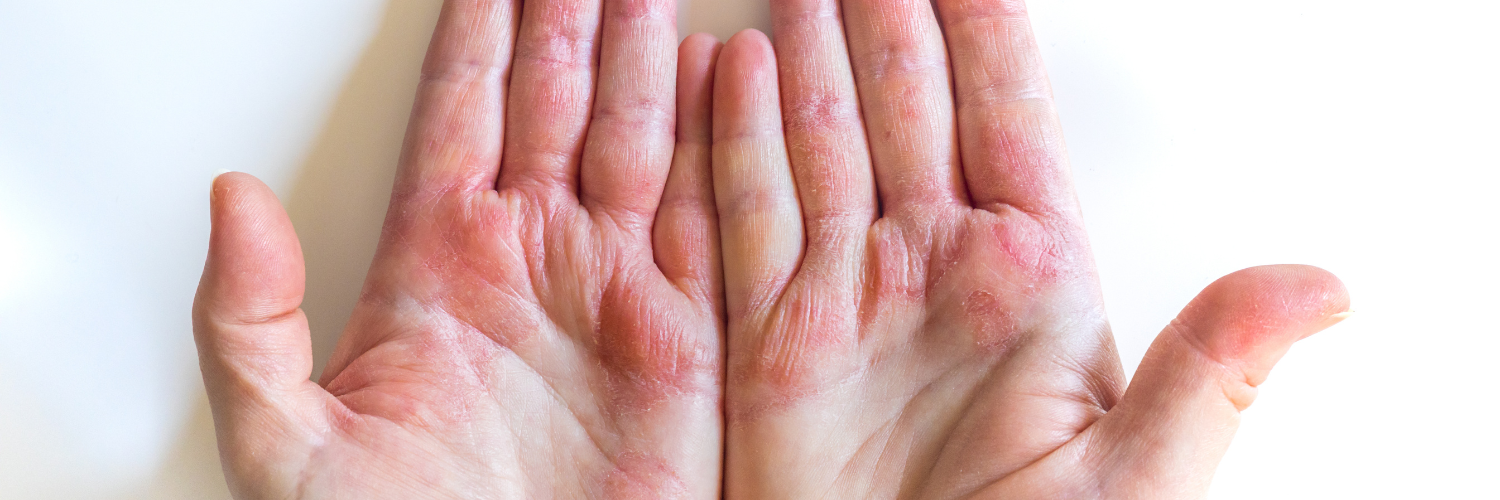 Hands with eczema - Using Goat Milk Soap for Eczema
